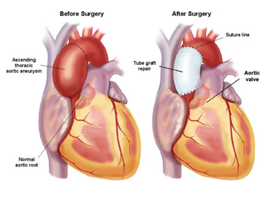 aneurisma aniousis aortis