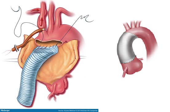 aneurisma aniousis aortis kai imitoksou
