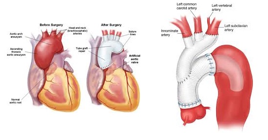 aneurisma aortikou toksou